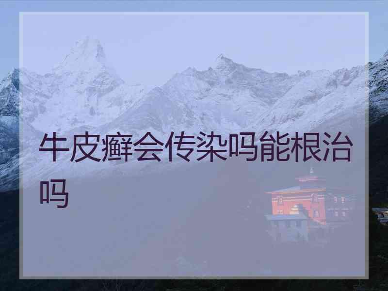 牛皮癣会传染吗能根治吗